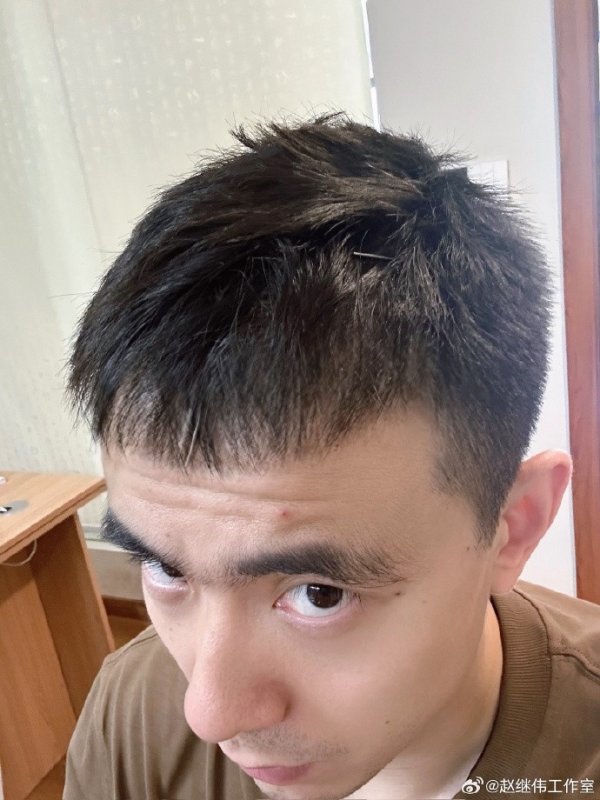 工作室晒赵继伟头&喉咙针灸图片：嗓子治疗进入下一阶段 助威  💪